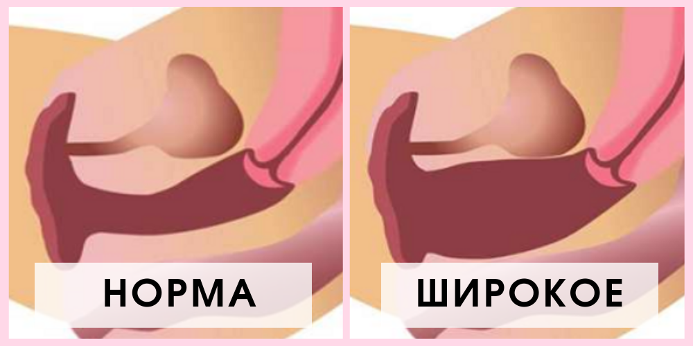 Сравнение широкого и нормального влагалища